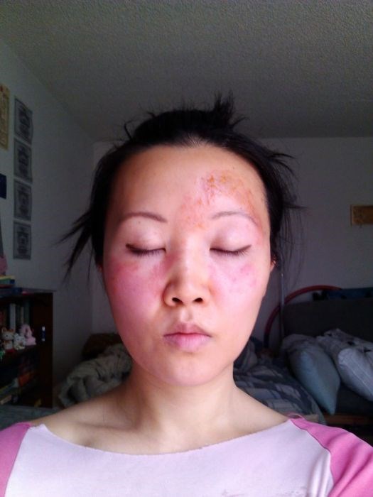 Чайна Чуу, chyna chuu, аллергия, самолечение, импетиго