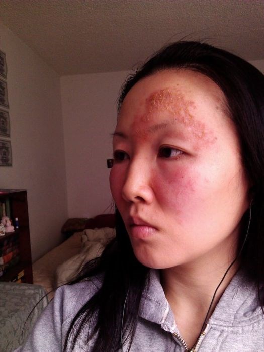 Чайна Чуу, chyna chuu, аллергия, самолечение, импетиго