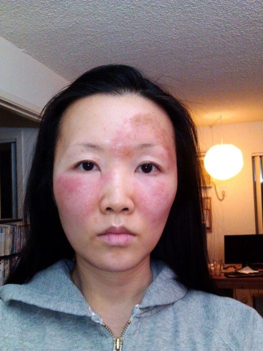 Чайна Чуу, chyna chuu, аллергия, самолечение, импетиго