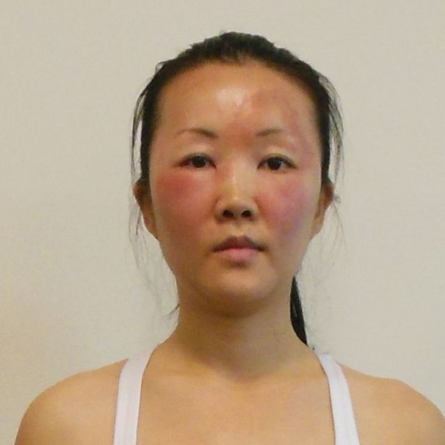 Чайна Чуу, chyna chuu, аллергия, самолечение, импетиго