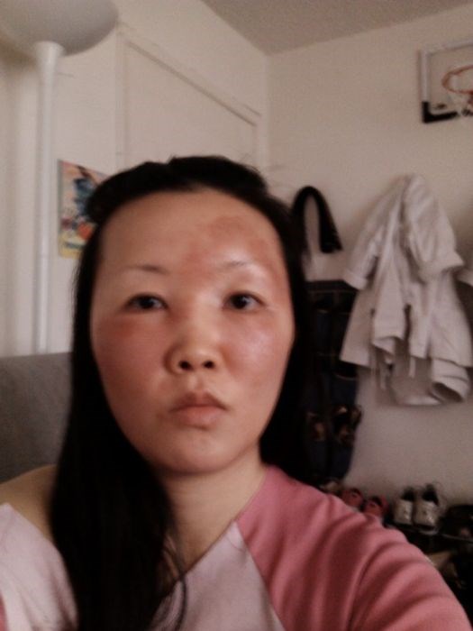 Чайна Чуу, chyna chuu, аллергия, самолечение, импетиго