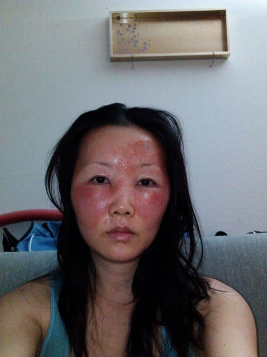 Чайна Чуу, chyna chuu, аллергия, самолечение, импетиго
