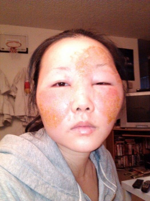 Чайна Чуу, chyna chuu, аллергия, самолечение, импетиго