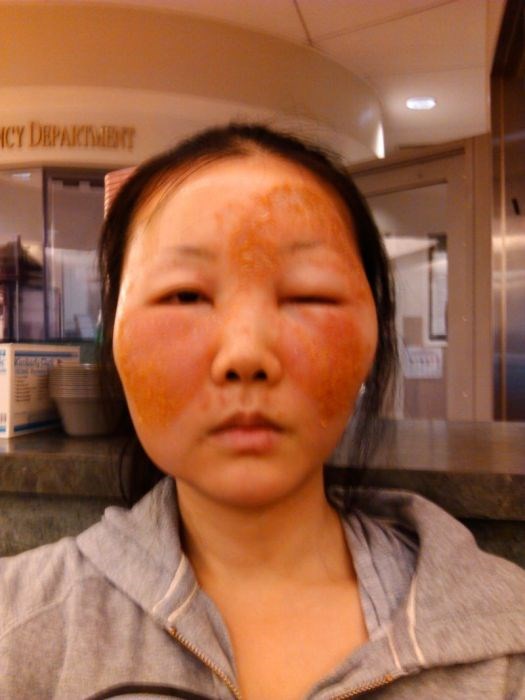 Чайна Чуу, chyna chuu, аллергия, самолечение, импетиго