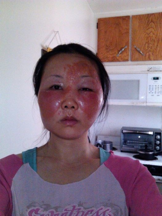 Чайна Чуу, chyna chuu, аллергия, самолечение, импетиго