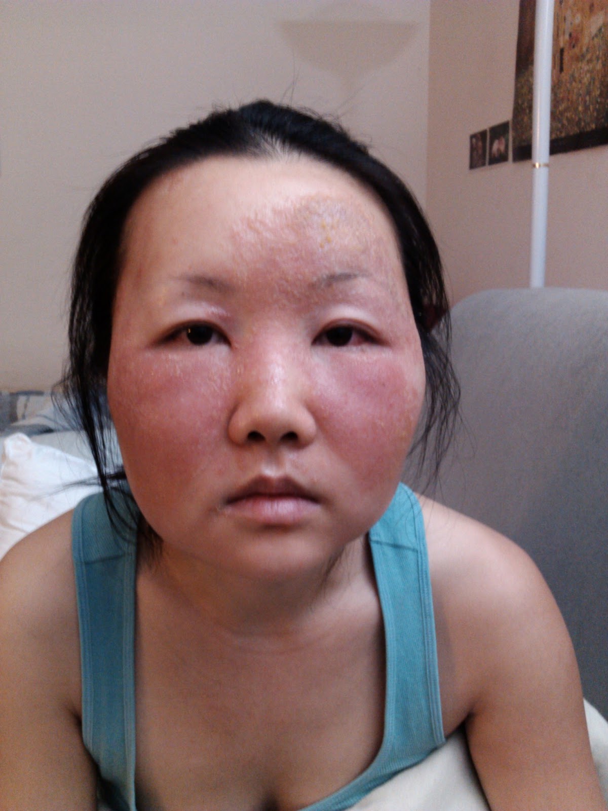 Чайна Чуу, chyna chuu, аллергия, самолечение, импетиго