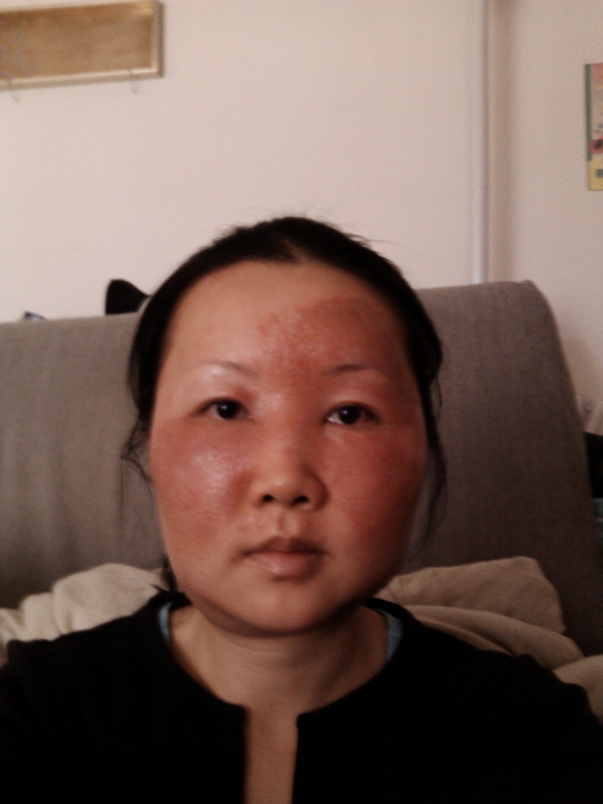 Чайна Чуу, chyna chuu, аллергия, самолечение, импетиго