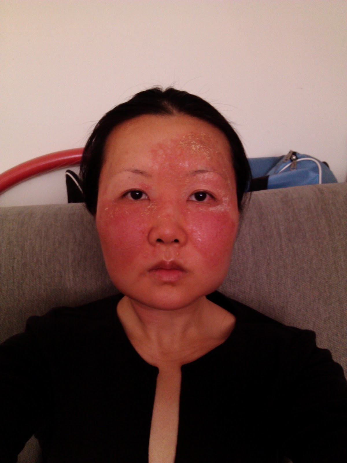 Чайна Чуу, chyna chuu, аллергия, самолечение, импетиго