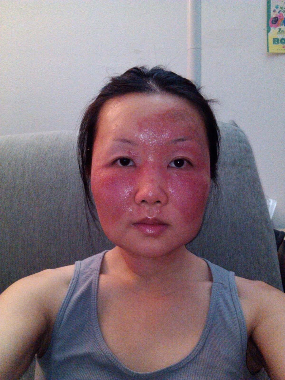 Чайна Чуу, chyna chuu, аллергия, самолечение, импетиго