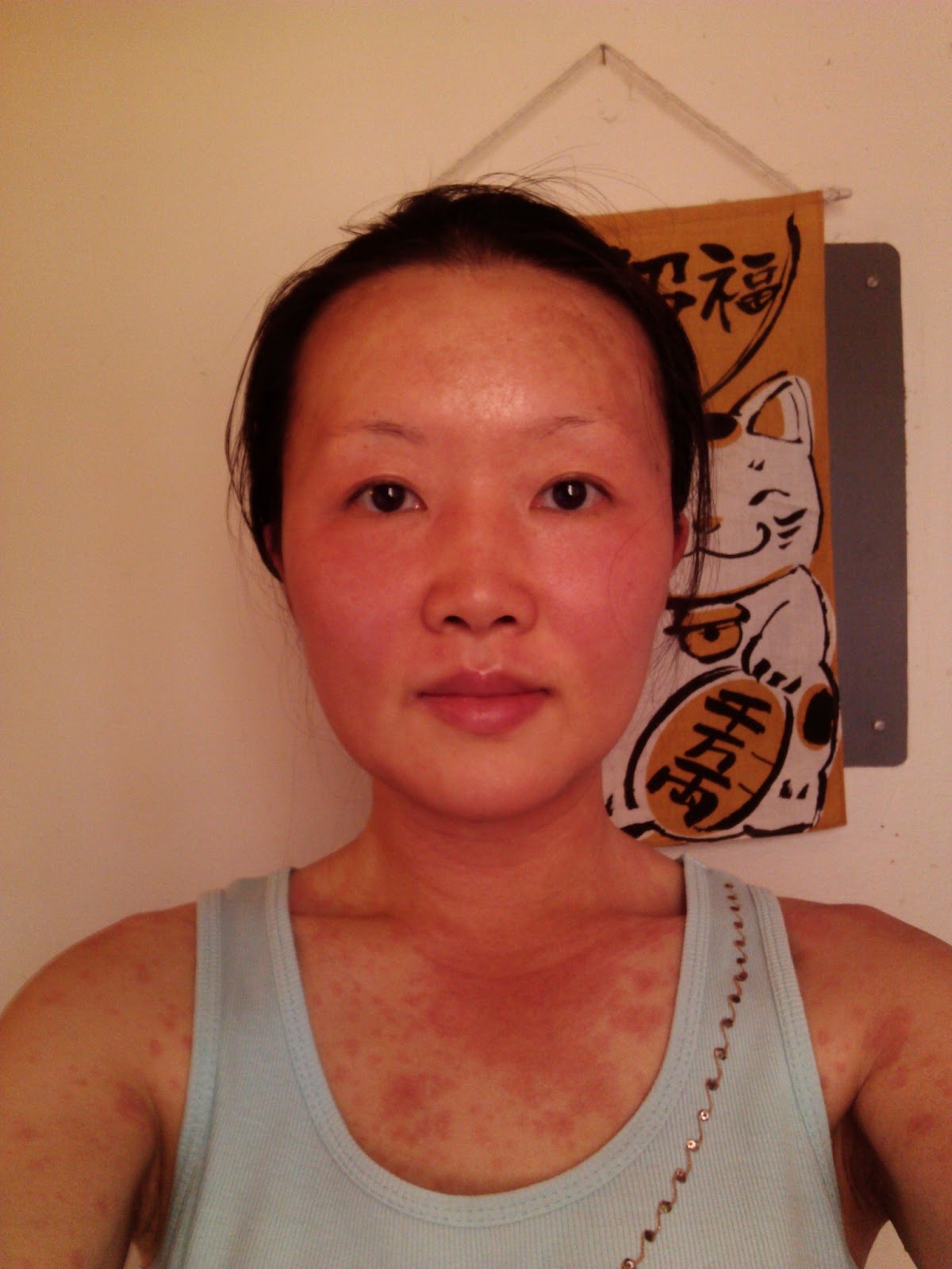 Чайна Чуу, chyna chuu, аллергия, самолечение, импетиго