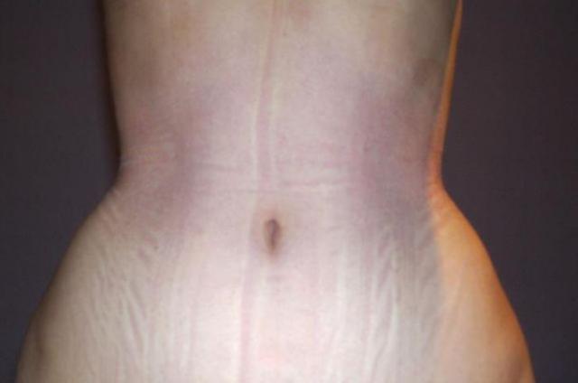 На что пошла девушка ради осиной талии Мишель Кобке, корсет 3 года, осиная тонкая талия 40 см