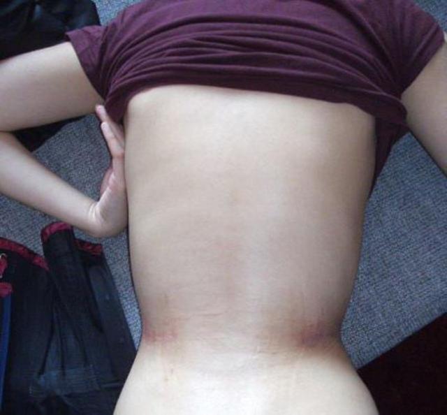 На что пошла девушка ради осиной талии Мишель Кобке, корсет 3 года, осиная тонкая талия 40 см