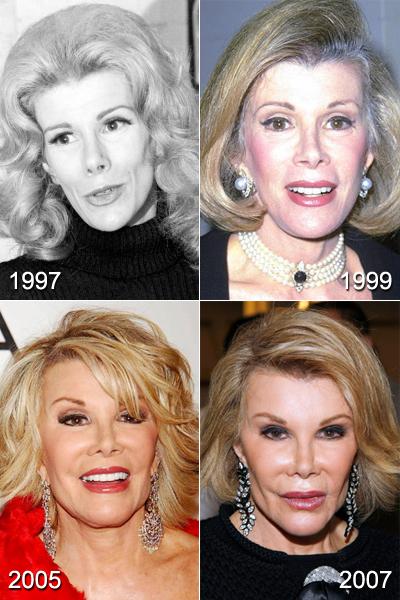 Жертвы, пластические операции, Голливуд, Богдановы, Сталлоне, Версаче, Риверз