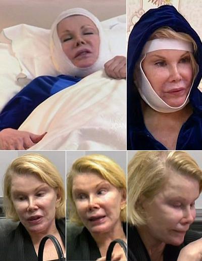 Жертвы, пластические операции, Голливуд, Богдановы, Сталлоне, Версаче, Риверз