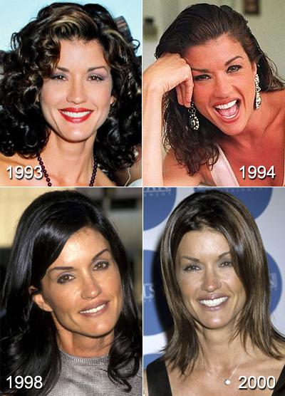 Жертвы, пластические операции, Голливуд, Богдановы, Сталлоне, Версаче, Риверз