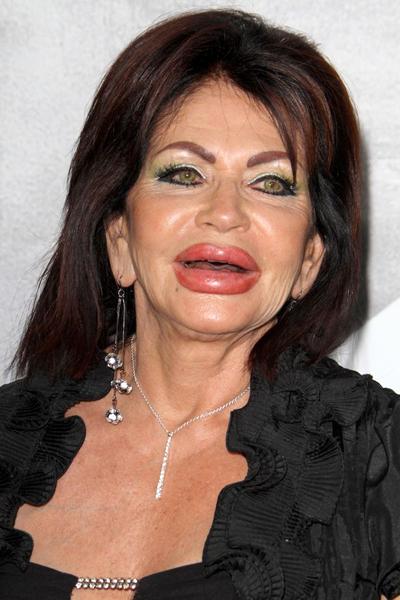 Жертвы, пластические операции, Голливуд, Богдановы, Сталлоне, Версаче, Риверз