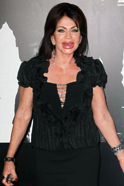 Жертвы, пластические операции, Голливуд, Богдановы, Сталлоне, Версаче, Риверз