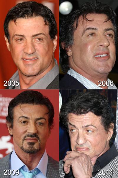 Жертвы, пластические операции, Голливуд, Богдановы, Сталлоне, Версаче, Риверз