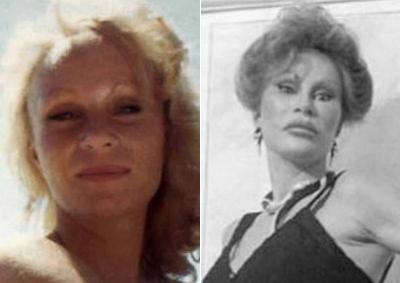 Жертвы, пластические операции, Голливуд, Богдановы, Сталлоне, Версаче, Риверз