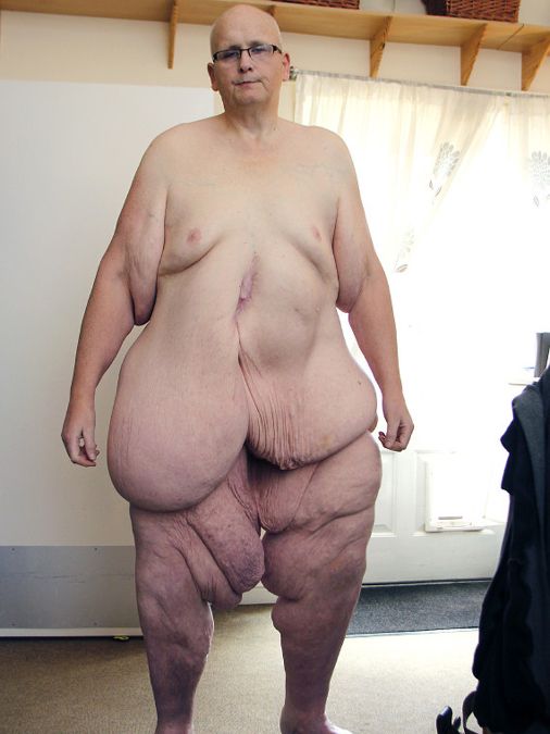 Пол Мэйсон, 300кг, кожа, операция