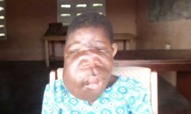 Гана,сиротка-инвалид,лицевое уродство, Гана, Tumblr,операция,болезнь