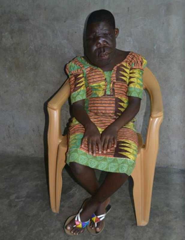 Гана,сиротка-инвалид,лицевое уродство, Гана, Tumblr,операция,болезнь