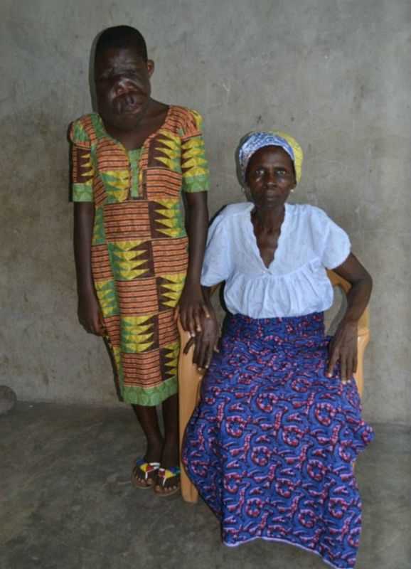 Гана,сиротка-инвалид,лицевое уродство, Гана, Tumblr,операция,болезнь