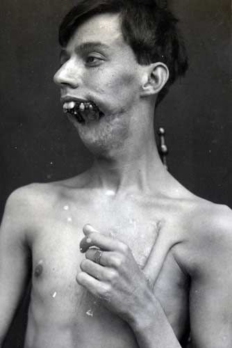 первые в мире пластические операции, люди перенесшие первые пластические операции, первые в истории пластические операции