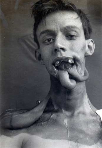 первые в мире пластические операции, люди перенесшие первые пластические операции, первые в истории пластические операции