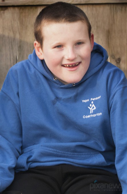 Мальчик с вечной улыбкой на лице Джеймс Эдгар,улыбка,синдром Ангельмана