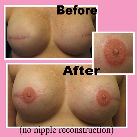 Татуировки, тату, на женской, груди, шрам, мастэктомия, женщины, рак, операции