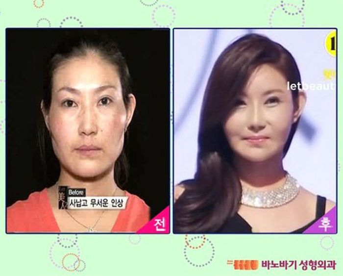 Корейские пластические операции до и после фото