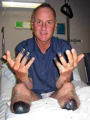 Безумный альпинист покорил Эверест без ног! Марк Инглис, альпинист без ног, Эверест