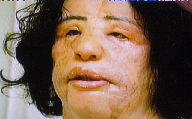 Жертвы, пластическая хирургия, шок , пластика