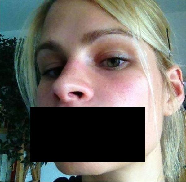 Чудо-средство для увеличения губ ботокс, укус пчелы, аллергия на укус