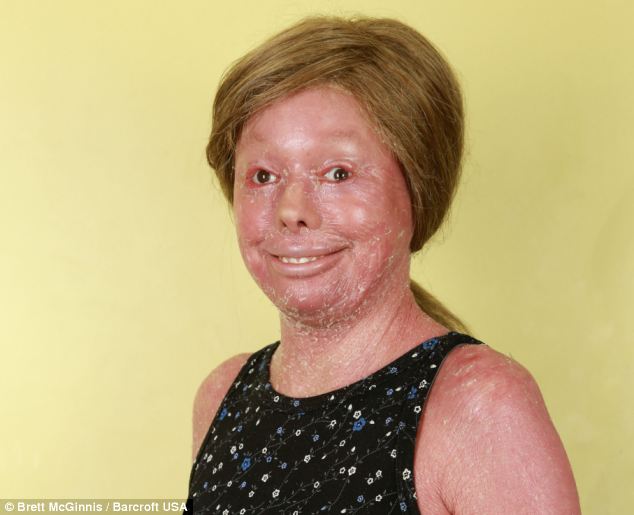 Хантер Стейниц, hunter steinitz, ихтиоз арлекина, болезнь