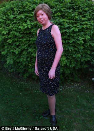 Хантер Стейниц, hunter steinitz, ихтиоз арлекина, болезнь