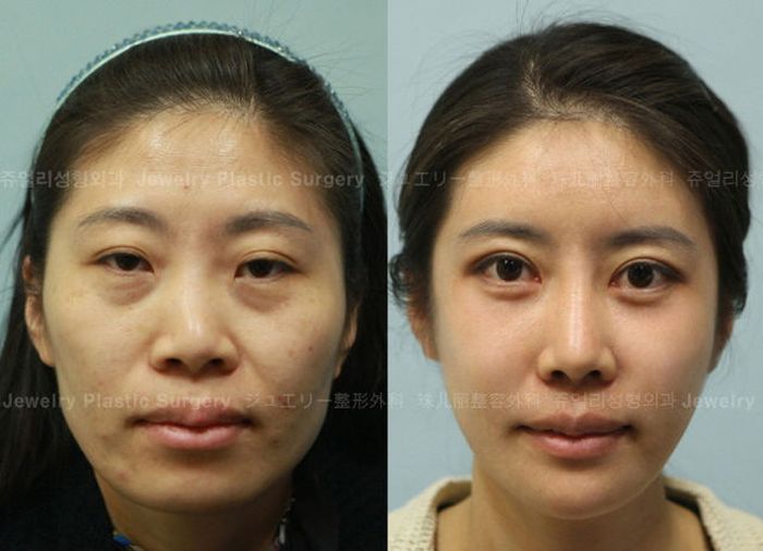 Корейские пластические операции до и после фото