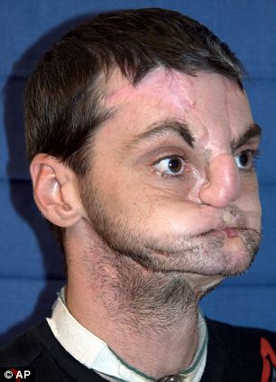 Восстановление, пересадка лица, Ричард Норрис, трансплантация