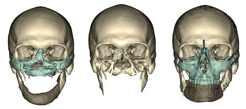 Восстановление, пересадка лица, Ричард Норрис, трансплантация