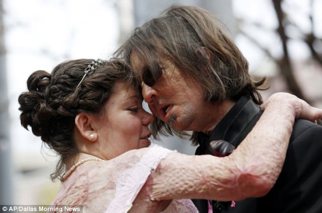 Человек без лица женился! Человек, без, лица, женился, Даллас, Винс, Нэш, ожог, удар током