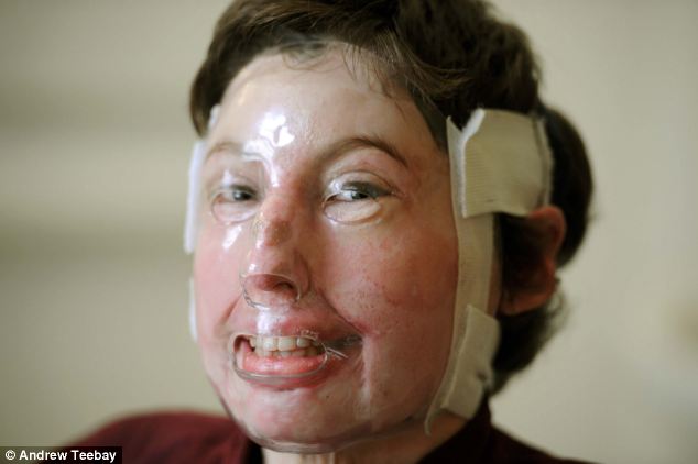 96% ожогов тела 200 операций, Катрин Пью,Catrin Pugh, девушка сгорела в автобусе, французские альпы