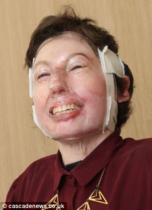 96% ожогов тела 200 операций, Катрин Пью,Catrin Pugh, девушка сгорела в автобусе, французские альпы