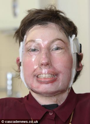 96% ожогов тела 200 операций, Катрин Пью,Catrin Pugh, девушка сгорела в автобусе, французские альпы