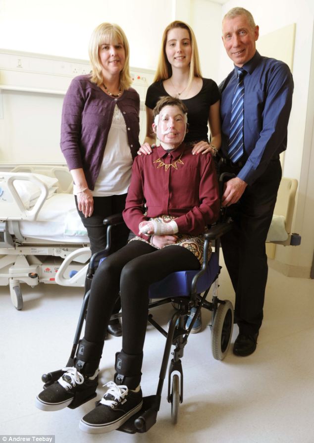 96% ожогов тела 200 операций, Катрин Пью,Catrin Pugh, девушка сгорела в автобусе, французские альпы