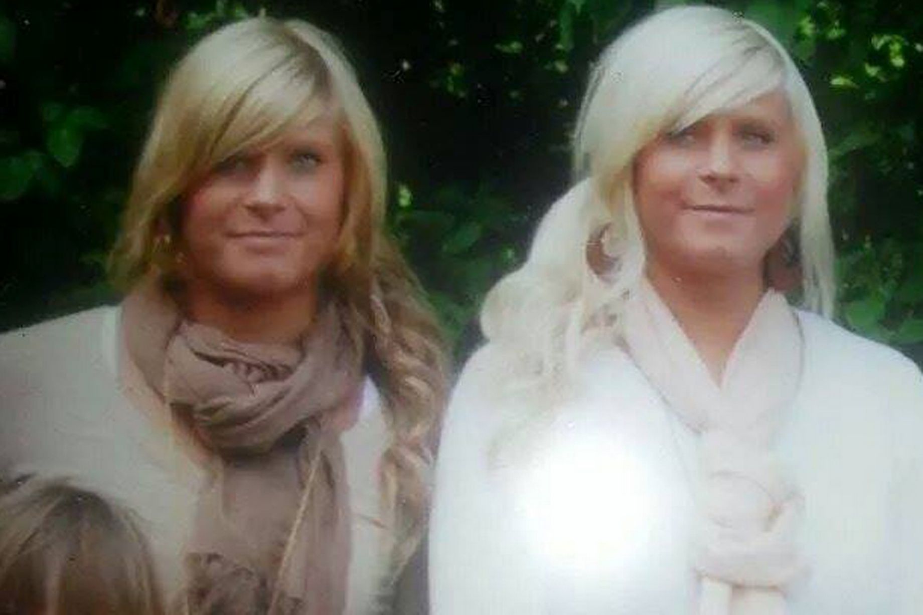 Emma and Sara Koponen, близняшки Сара и Эмма Копонен, близнецы пластические операции 