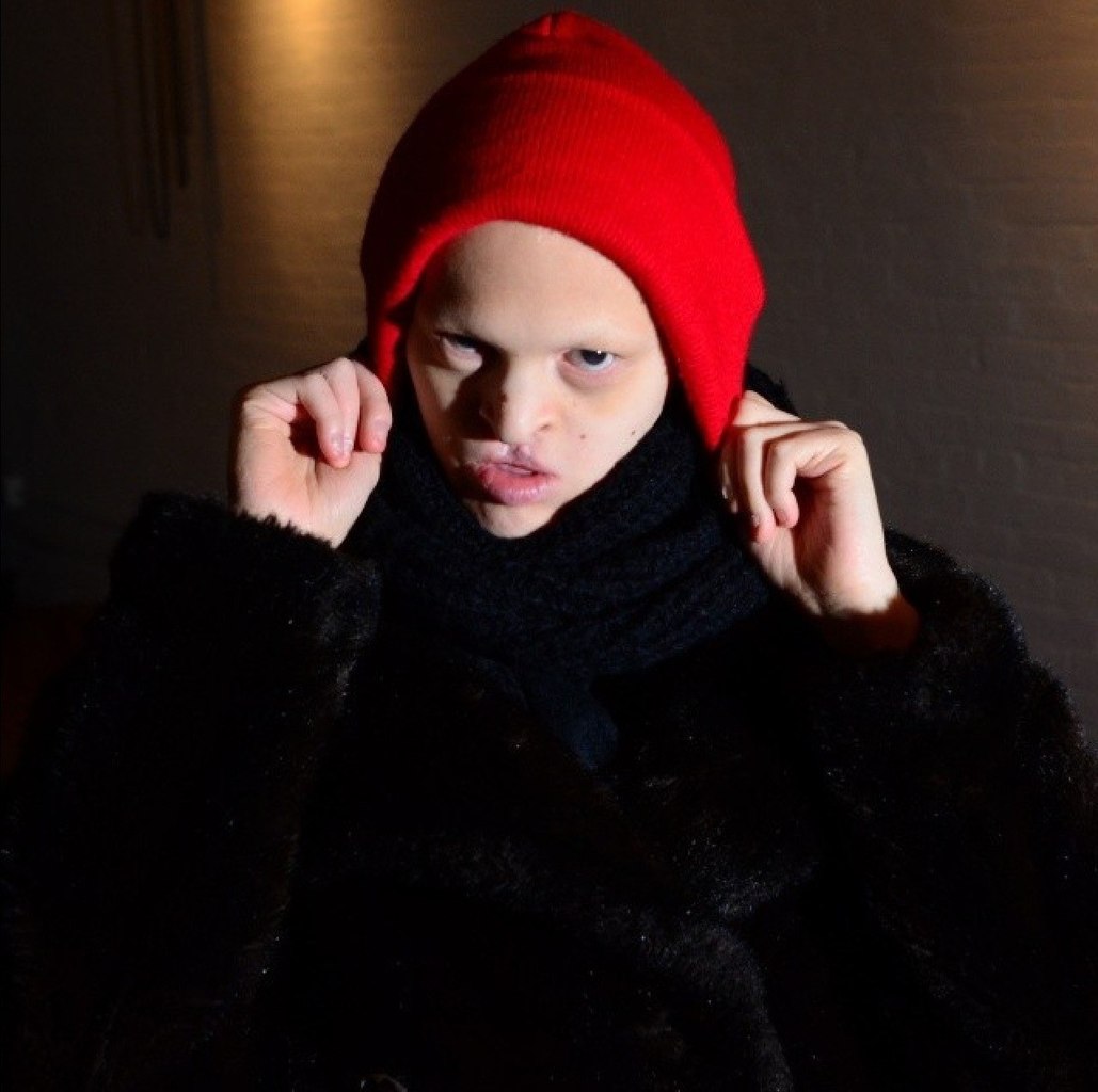 Мелани Гайдос Melanie Gaydos, эктодермальная дисплазия, модель с необычной внешностью,