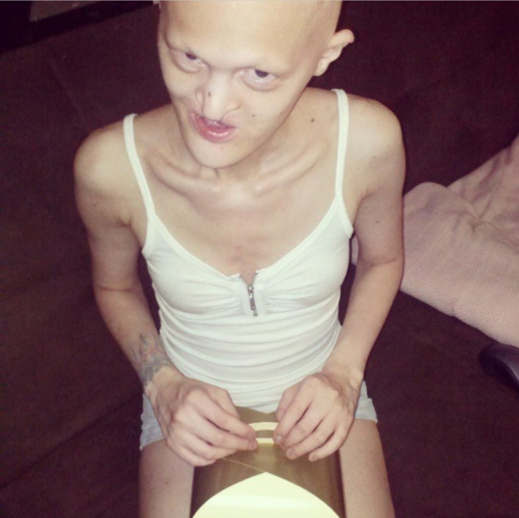 Мелани Гайдос Melanie Gaydos, эктодермальная дисплазия, модель с необычной внешностью,