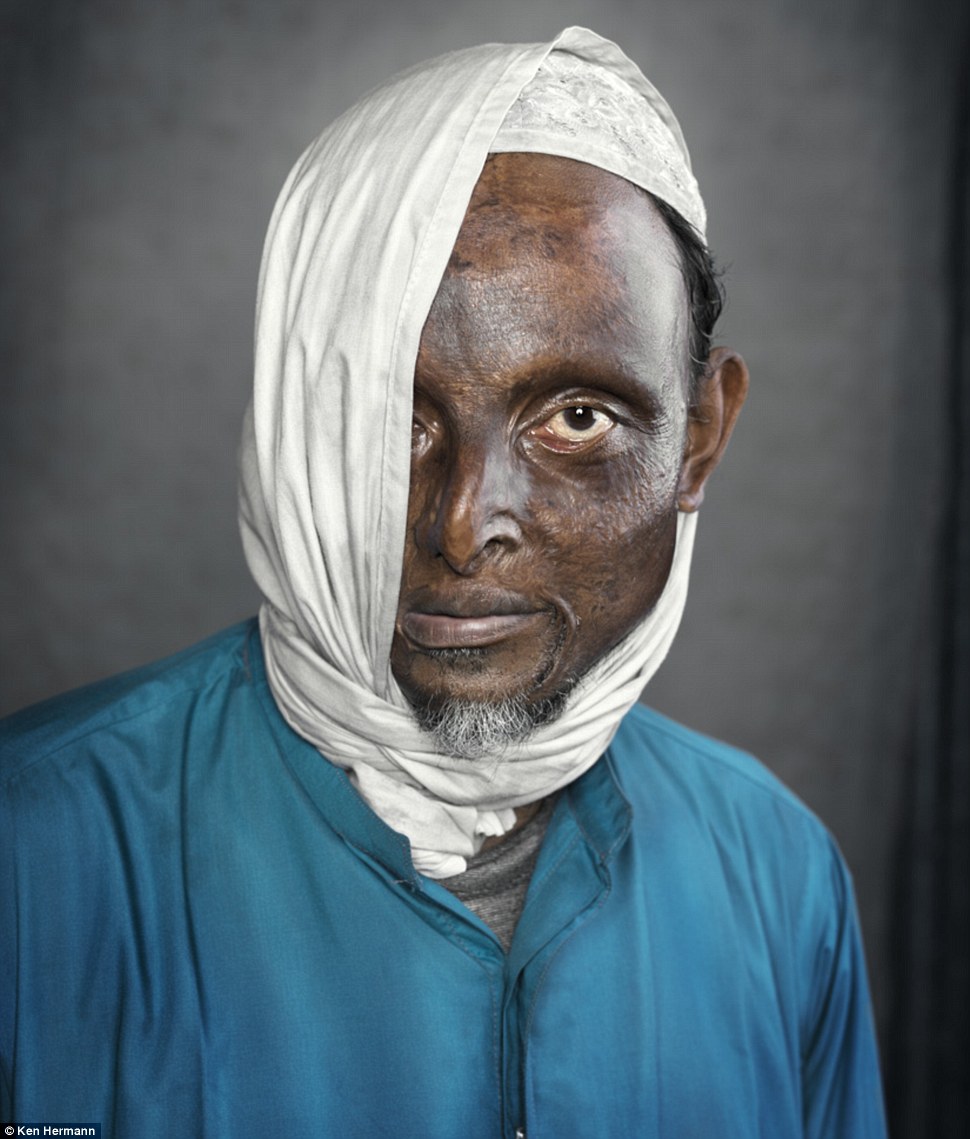 Жители Бангладеш, облитые кислотой, рассказывают о причинах своих ужасных увечий Бангладеш кислота, Кен Германн Ken Hermann, люди облитые кислотой