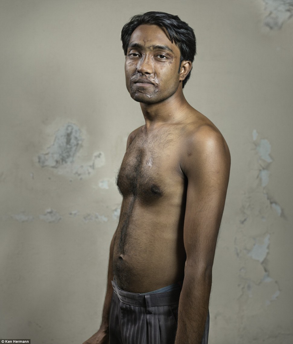 Жители Бангладеш, облитые кислотой, рассказывают о причинах своих ужасных увечий Бангладеш кислота, Кен Германн Ken Hermann, люди облитые кислотой